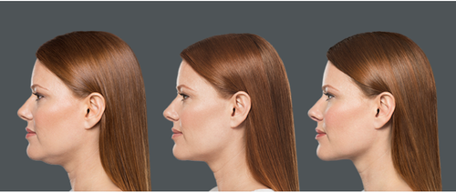 Female Before and After Kybella Treatment Image in San Diego, CA | Botoxie