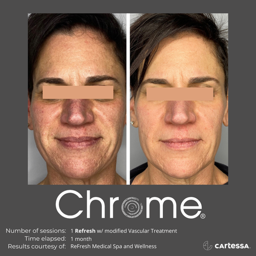 Female Before and After Chrome Treatment Image in San Diego, CA | Botoxie
