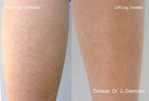 Before and After Laser Hair Removal Treatment Image in San Diego, CA | Botoxie