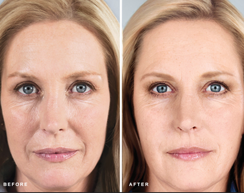 Female Before and After Sculptra Treatment Image in San Diego, CA | Botoxie