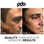 Young Male Before and After PDO Thread Lift Treatment Image in San Diego, CA | Botoxie