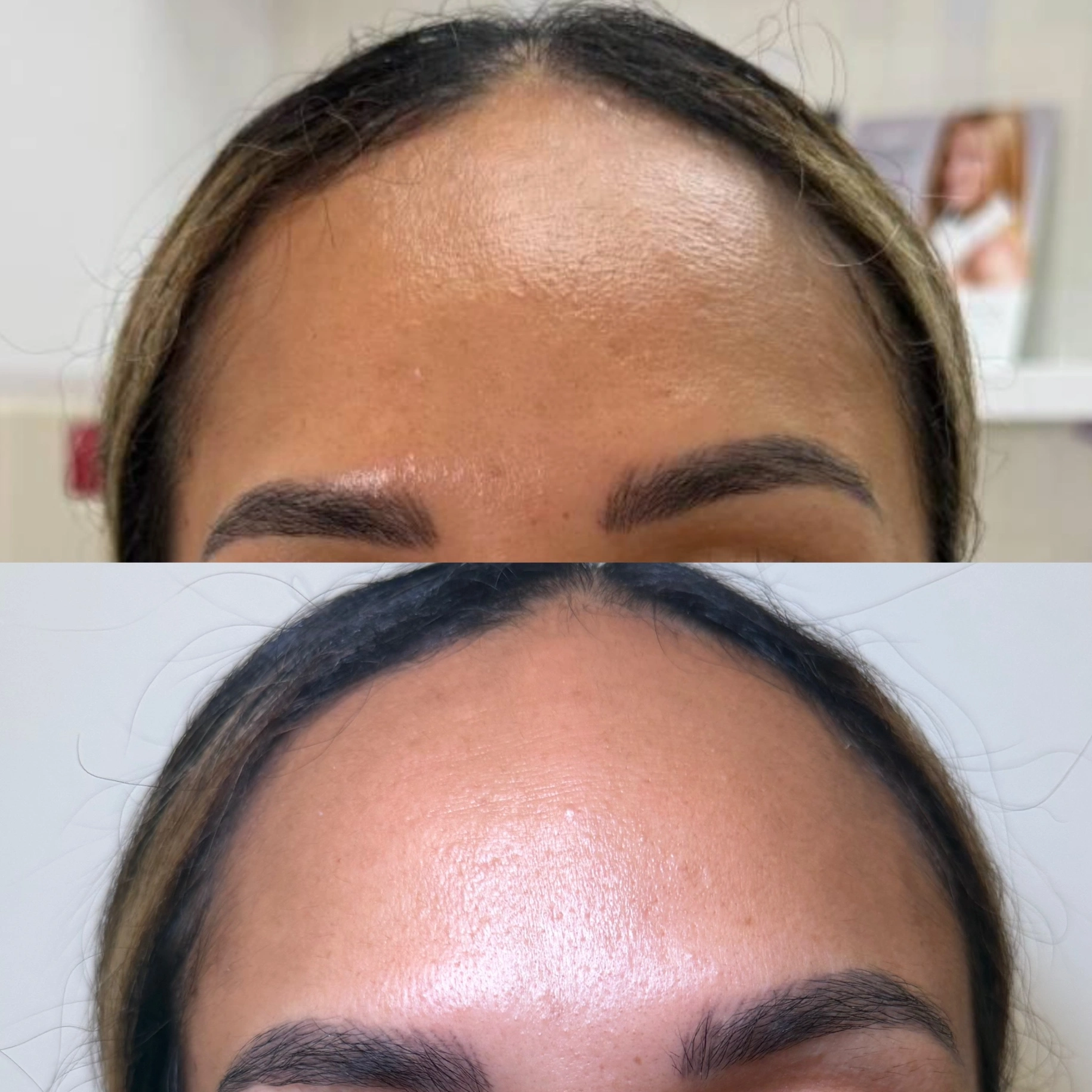ACNE SCARS