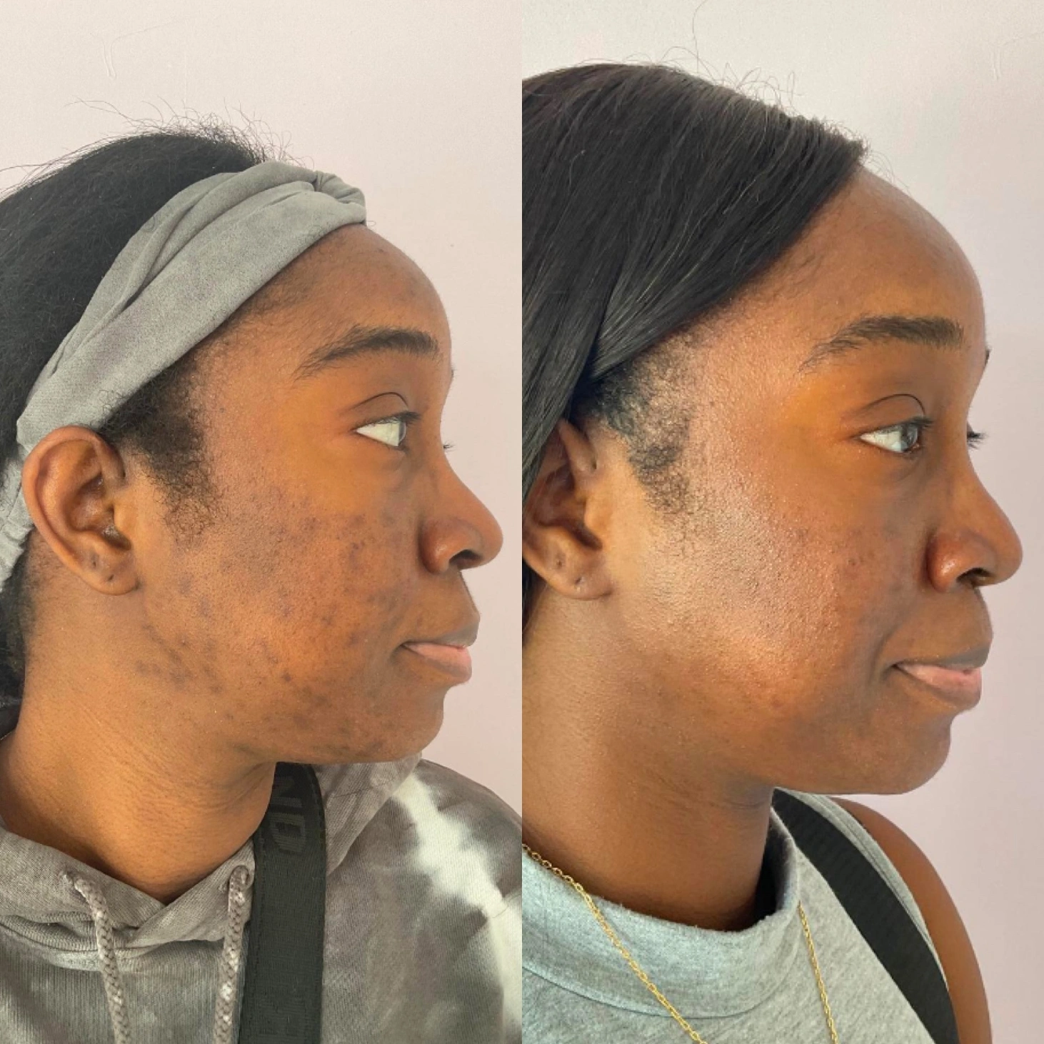 PORE APPEARANCE