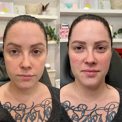 Botoxieca_Gallery_Dermal_Fillers_g