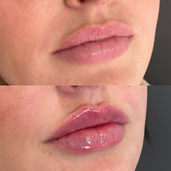 Young Female Before and After Dermal Fillers Treatment Image in San Diego, CA | Botoxie