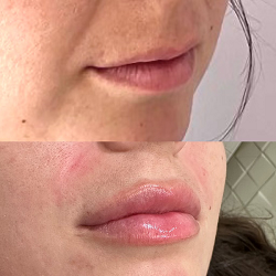 Young Female Before and After Dermal Fillers Treatment Photo in San Diego, CA | Botoxie