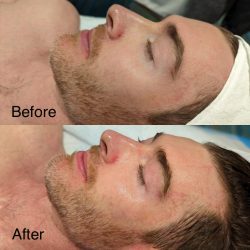 Male Before and After Facials Treatment Image in San Diego, CA | Botoxie