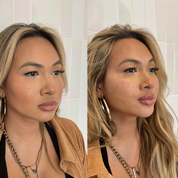 Young Female Before and After Dermal Fillers Treatment Photo in San Diego, CA | Botoxie