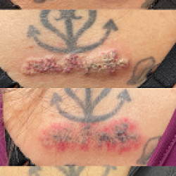 Before and After Tattoo Removal Treatment Photo in San Diego, CA | Botoxie