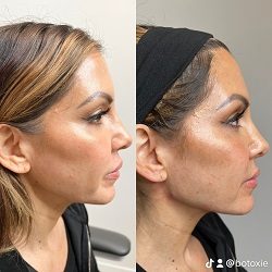 Young Female Before and After Treatment Photo in San Diego, CA | Botoxie