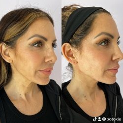 Young Female Before and After Treatment Photo in San Diego, CA | Botoxie
