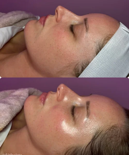 Hydrafacial-Before-and-After (1)