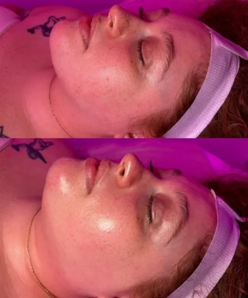 Hydrafacial-Before-and-After (2)