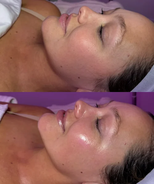 Hydrafacial-Before-and-After (3)