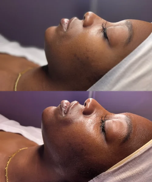 Hydrafacial-Before-and-After