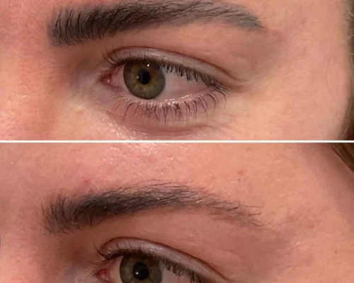 Eyebrow Tattoo Removal
