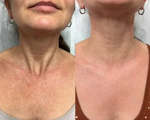 PICO Chest