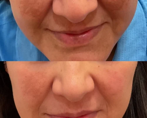 Pigment Removal