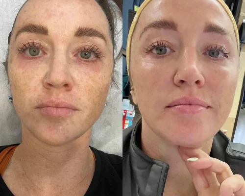 Before and after skin treatment showing reduced pigmentation, fewer dark spots, and brighter, more even skin tone.