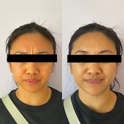 Female Before and After Botox Treatment Image in San Diego, CA | Botoxie