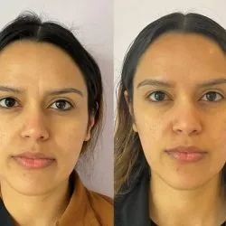 Female Before and After Botox Treatment Image in San Diego, CA | Botoxie