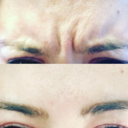 Female Before and After Botox Treatment Image in San Diego, CA | Botoxie