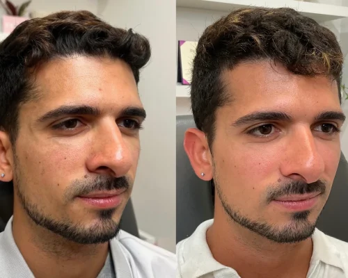 sculptra-before-after (1)
