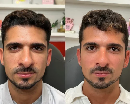sculptra-before-after (2)