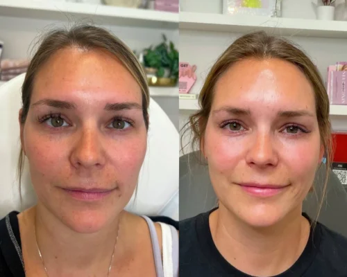 sculptra-before-after (3)