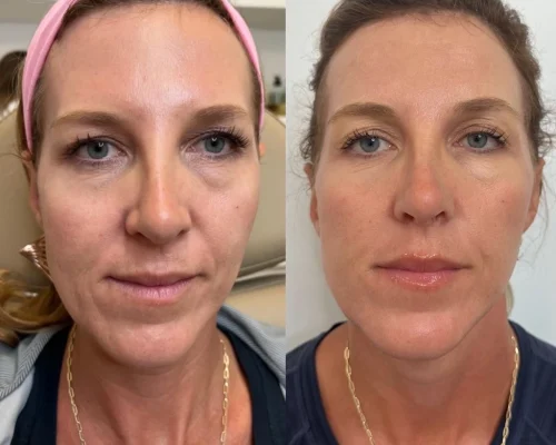 sculptra-before-after (4)