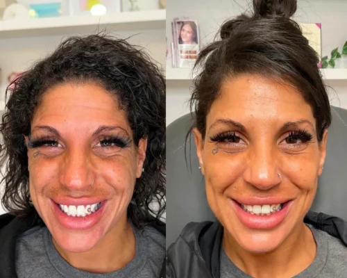 sculptra-before-after (5)